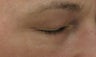 Fraxel re:pair "Blepharoplasty" for excess eyelid skin