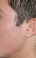 Fraxel Repair for  Acne