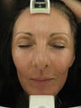 Fraxel re:pair CO2 laser resurfacing treatment