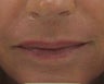 Fraxel re:pair (repair) CO2 laser resurfacing for scar improvement