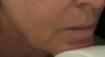 Fraxel Repair for Nonsurgical Facelift