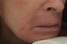 Fraxel repair for Lip, Marionette, and Nasolabial Lines