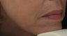 Fraxel re:pair (repair) CO2 laser for Mouth, Jowls, and Lips