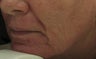 Before and After Fraxel re:pair CO2 laser resurfacing on lips, cheeks, mouth