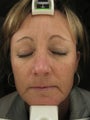 Fraxel re:pair CO2 laser resurfacing 4 month picture