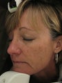 Fraxel re:pair CO laser resurfacing for fine lines and pigmentation