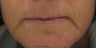 Fraxel re:pair for upper lip lines after 1 treatment