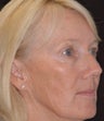 Fraxel re:pair CO laser resurfacing for lips, cheeks, and eye wrinkles