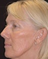 Fraxel re:pair CO2 laser resurfacing for lips, cheeks, marionette lines