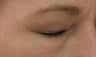 Fraxel re:pair "Blepharoplasty" for excess eyelid skin
