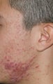 Fraxel Repair for  Acne