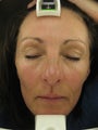 Fraxel re:pair CO2 laser resurfacing treatment