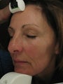 Fraxel re:pair laser treatment