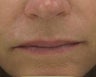 Fraxel re:pair (repair) CO2 laser resurfacing for scar improvement