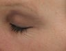 Fraxel re:pair (repair) Fractional CO2 Laser resurfacing Blepharoplasty