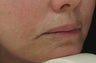 Fraxel Re:pair (repair) CO2 Laser Resurfacing Treatment around the mouth