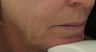 Fraxel Repair for Nonsurgical Facelift