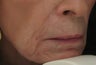 Fraxel repair for Lip, Marionette, and Nasolabial Lines
