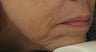 Fraxel re:pair (repair) CO2 laser for Mouth, Jowls, and Lips
