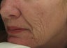 Before and After Fraxel re:pair CO2 laser resurfacing on lips, cheeks, mouth