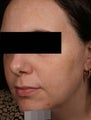 Melasma