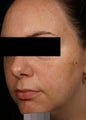 Melasma
