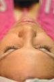 Chemical Peel