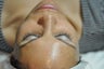 Chemical Peel