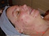 Green peel for acne treatment