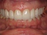 Gum Recontouring