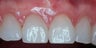 Gum Graft