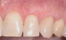 Gum Graft