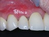 Gum Graft