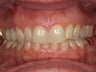 Gum Recontouring