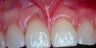 Gum Graft