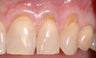 Gum Graft
