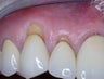 Gum Graft