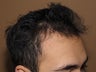 FUE Nograft hair transplantation