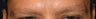 Eyebrow Transplant