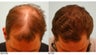 Hair Transplant