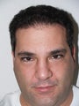 Hair Transplant