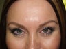 Eyebrow transplant 