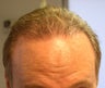 Male Hair Transplant