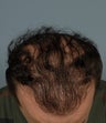 Hair Transplant