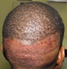 FUE hair transplant Neograft in  African American - donor site