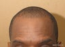 Neograft FUE hair transplant in African American