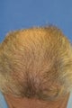Hair Transplant