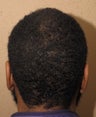 FUE hair transplant African American  donor site