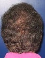 Hair Transplant 