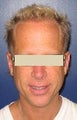 Hair Transplant 